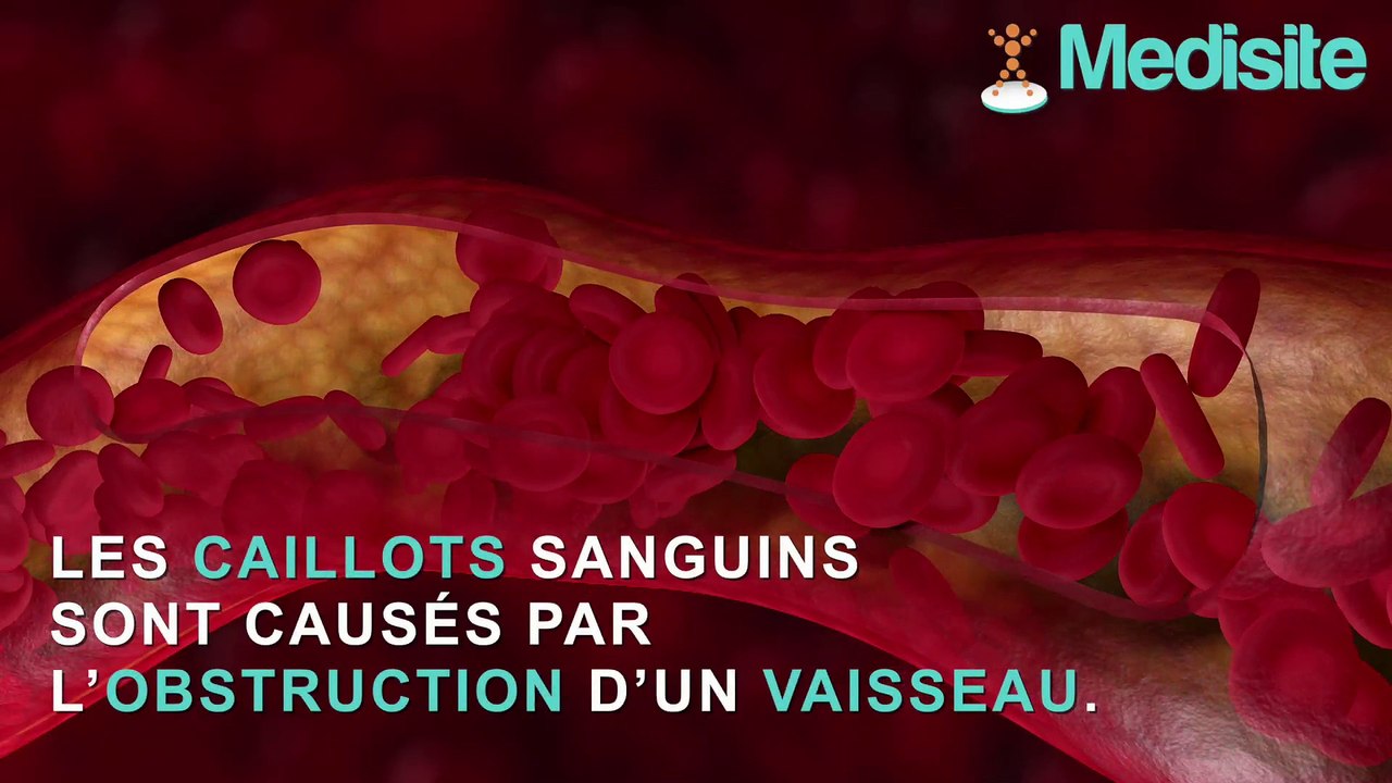 Caillot sanguin : quels sont les signes ? - Vidéo Dailymotion