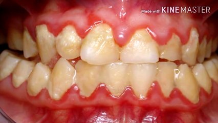 Elimina el sarro dental