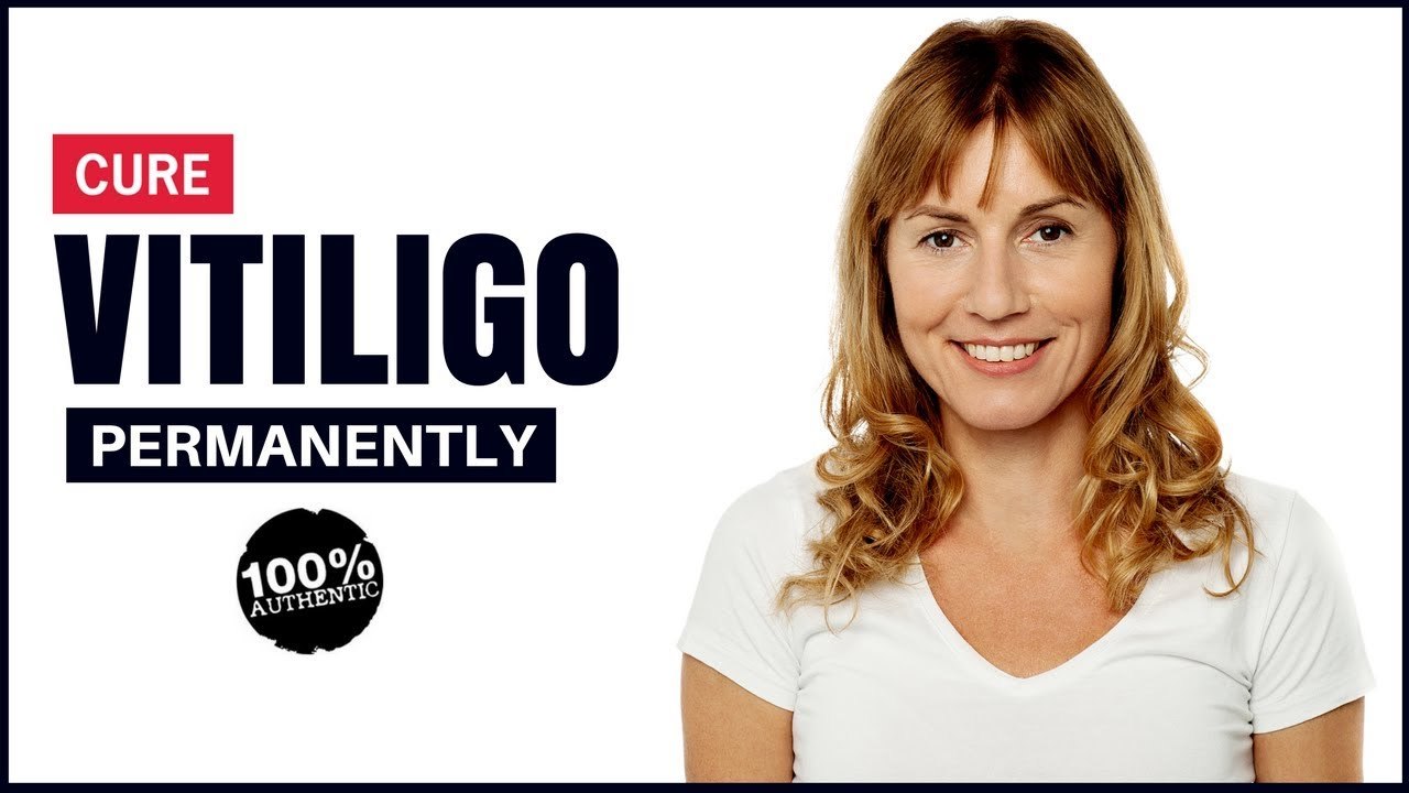 how to remove vitiligo from lips – Home remedies Treatment at home