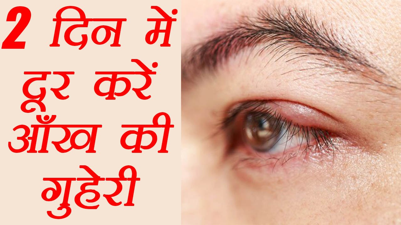 आंख की गुहेरी दूर करने के घरेलु उपाय | How to get rid of a Stye | Eye Care | Hordeolum | Boldsky
