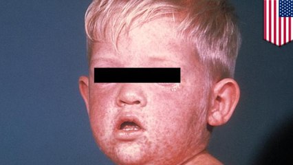 Measles warning issued for travellers at Chicago airport