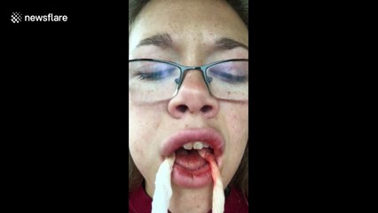 Girl finds a 'tampon' in her mouth after wisdom tooth surgery