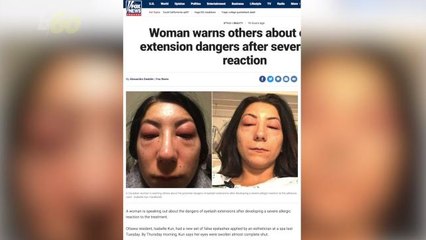 After Severe Reaction, Woman Warns Others About Eyelash Extension Dangers