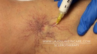 TOP 5 Sclerotherapy Videos of 2017: #1
