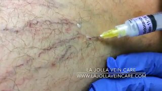 TOP 5 Sclerotherapy Videos of 2017: #5
