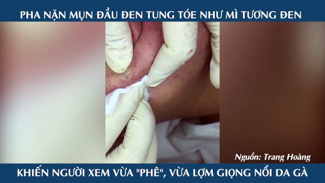PHA NẶN MỤN ĐẦU ĐEN TUNG TÓE NHƯ MÌ TƯƠNG ĐEN