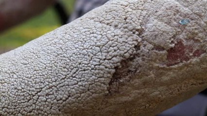 Hastalığı Değil, İnsanların Kendini Görünce Korkup Uzaklaşması Kahrediyor