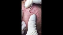 BIG Blackheads Extrion on Face / Full Session