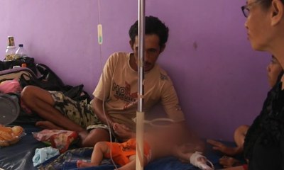 Terkena Air Panas, Mulut Bayi Ini Melepuh