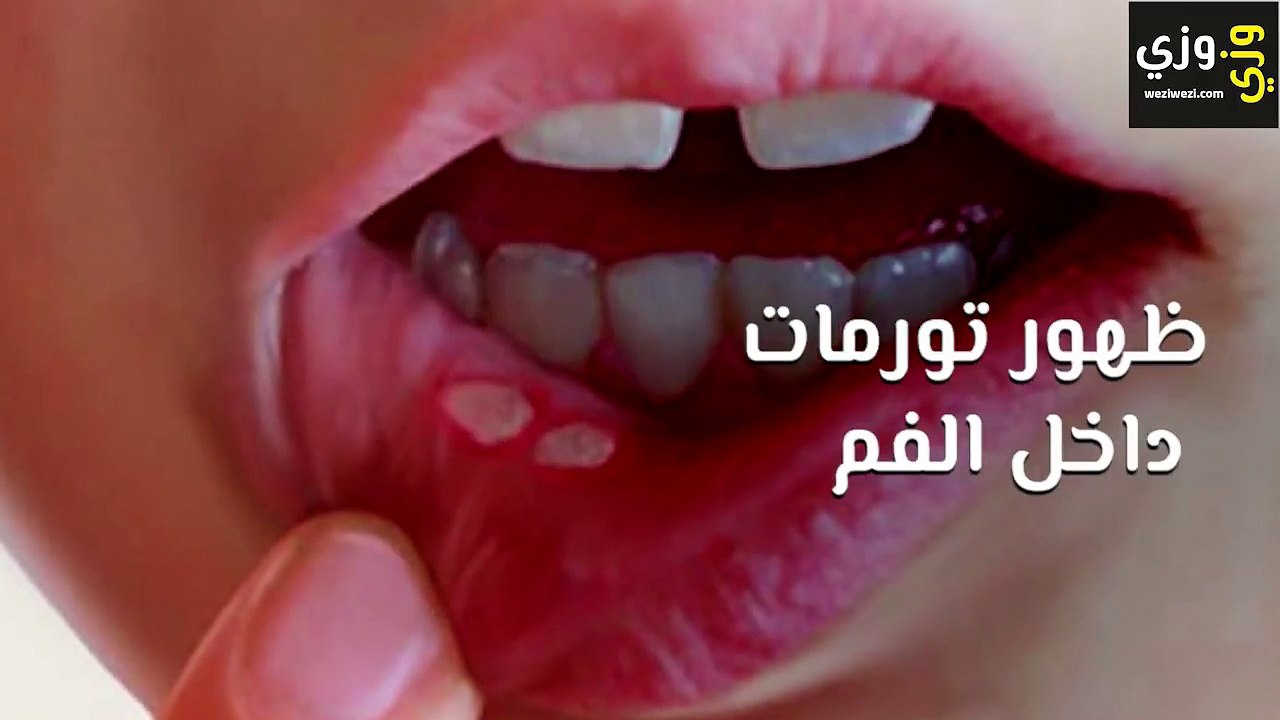 أعراض سرطان اللسان