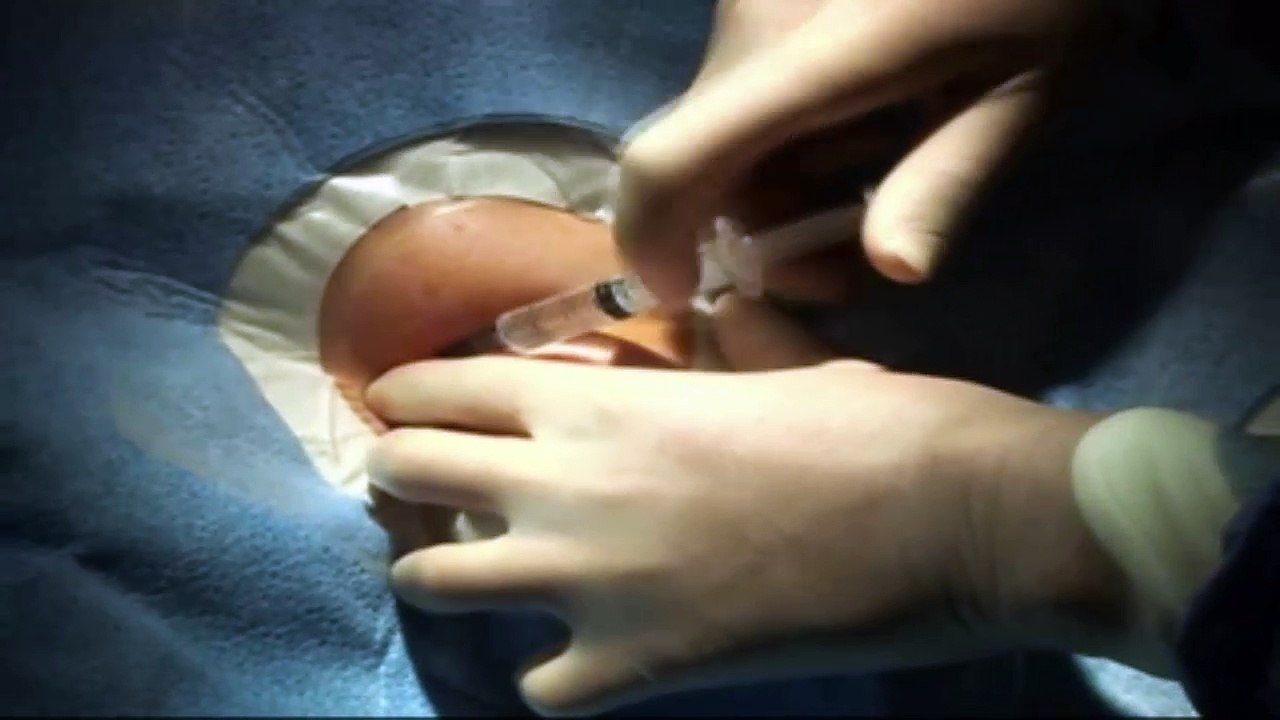 Central Venous Line Placement Subclavian Vein