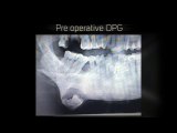 A Case of Simultaneous Ectopic Tooth Extraction and Removal