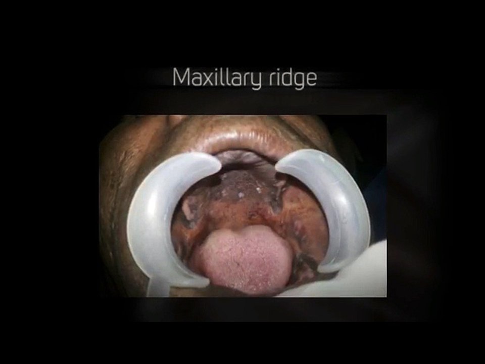 Is old age a risk factor for dental implants