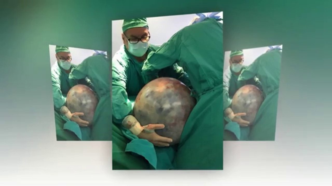 Ameliyatını 8 Yıl Boyunca Erteledi, Karnından 34 Kiloluk Tümör Çıkartıldı