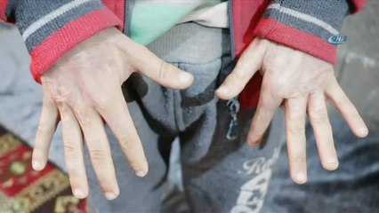 Esad’ın varil bombası 7 yaşındaki Mahmud’u yaktı