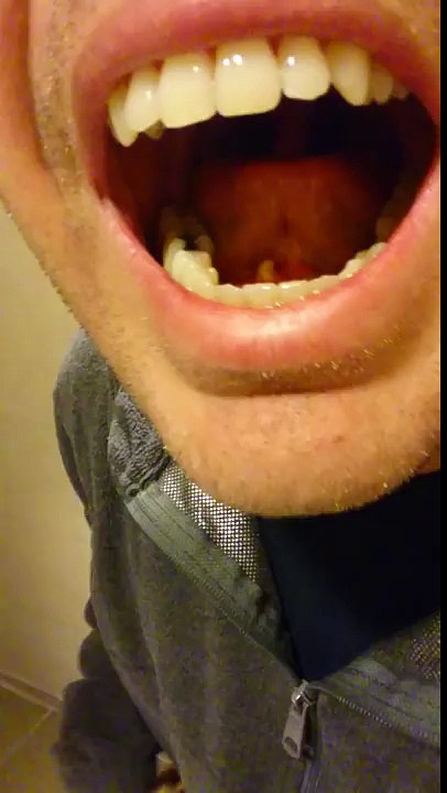 Salivary stone pooped out my tongue