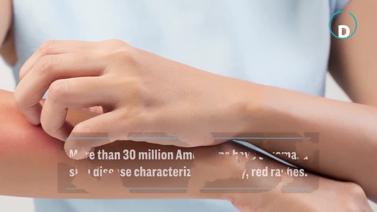 6 Reasons Your Eczema is Flaring Up