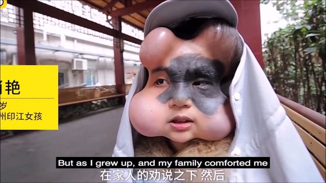 Des chirurgiens lui ont implanté 4 ballons afin d'effacer sa tache de naissance... Opération encore jamais vue