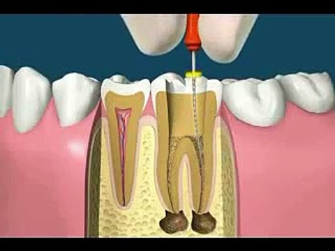 Endodontics (Root Canal Treatment)