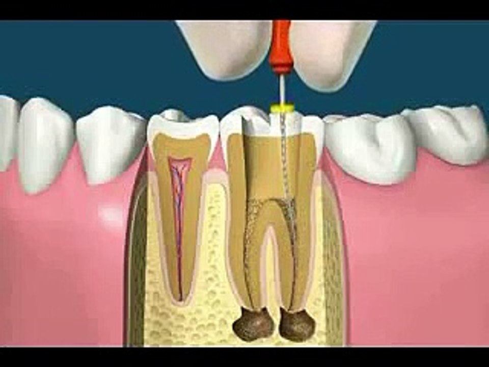 Endodontics (Root Canal Treatment)