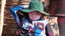 Albinismo: os direitos humanos contra crenças e mitos
