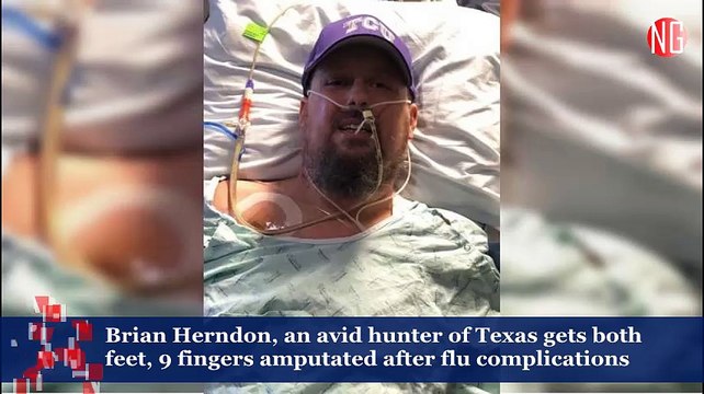 Flu Causes Man's Both Feet, 9 Fingers Amputated
