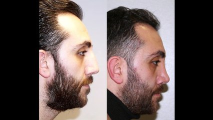 Mustafa Ali Yanık burunda şekil bozukluğu şikayet ile başvuran hastaları ve sonuçlarını paylaşıyor