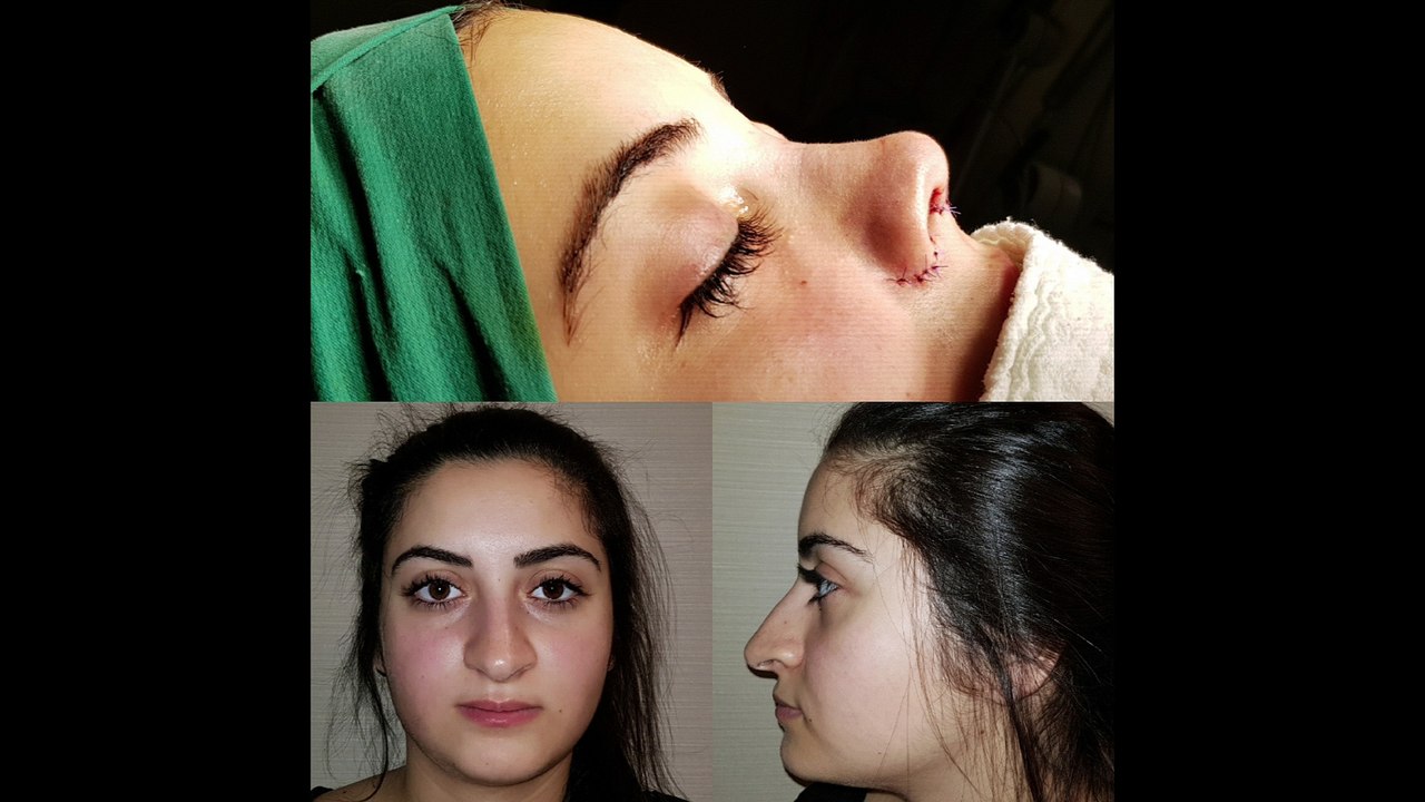 Op Dr Mustafa Ali Yanık Başarılı bir burun estetiğinin önemini anlatıyor. Mustafa Ali Yanık burun şikayet ve çözümleri