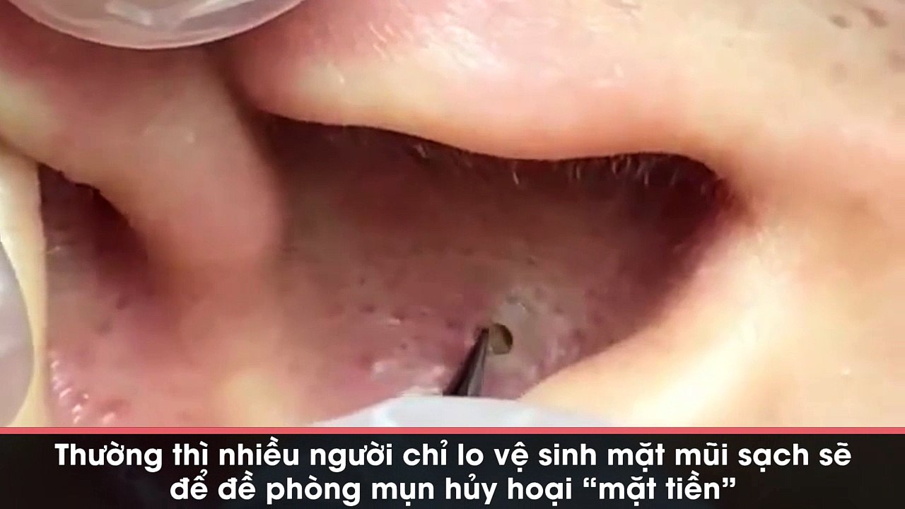 Pha nặn mụn "thủng lỗ" trong tai: Nhìn rất ghê nhưng lại thấy... phê