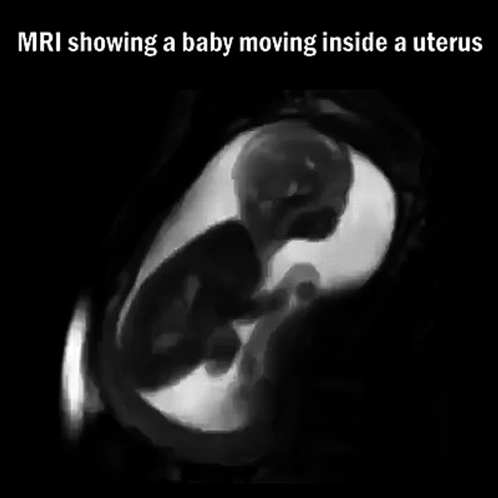 Il enregistre les mouvement d'un bébé dans le ventre de sa maman... Agité