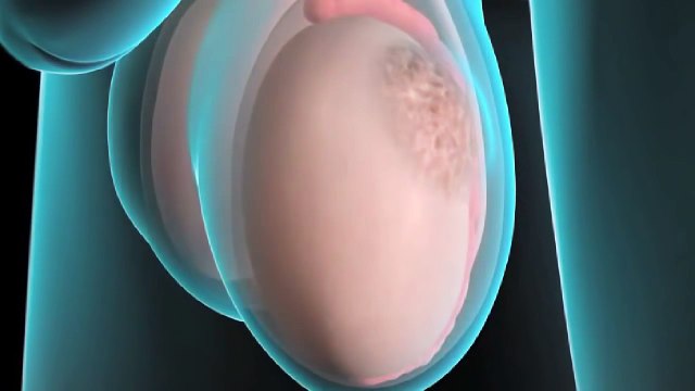 سرطان الخصية - أعراض سرطان الخصية و علاج سرطان الخصية