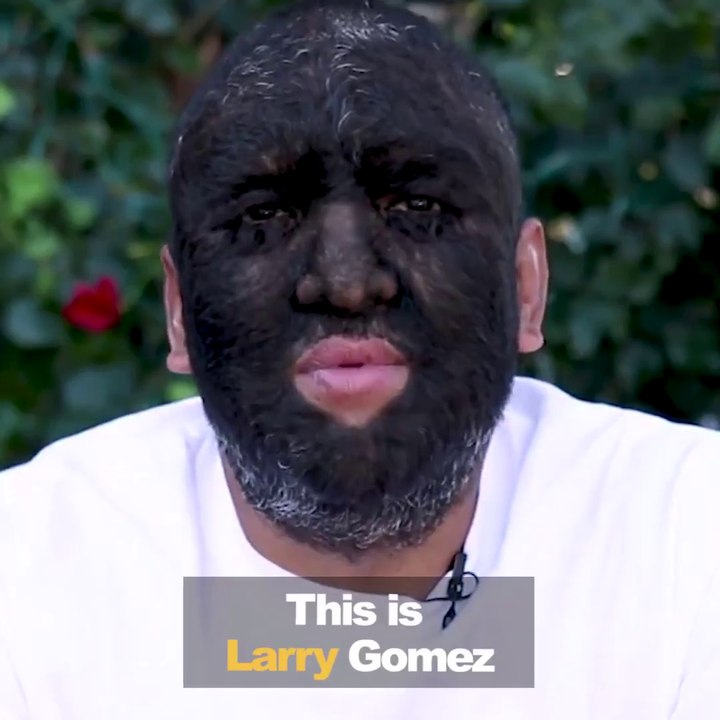 L'homme le plus poilu du monde. 98% de son corps recouvert de poil