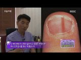 [Morning Show] Black cable in Nail, Toenail?! That's 'Melanoma' '흑생종'이에요[생방송 오늘 아침] 20150925
