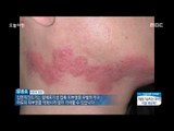 [Morning Show]Dermatitis, for duvets? 피부염, 이불 때문에?[생방송 오늘 아침] 20171207