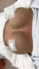 Nâng ngực kích cỡ khủng