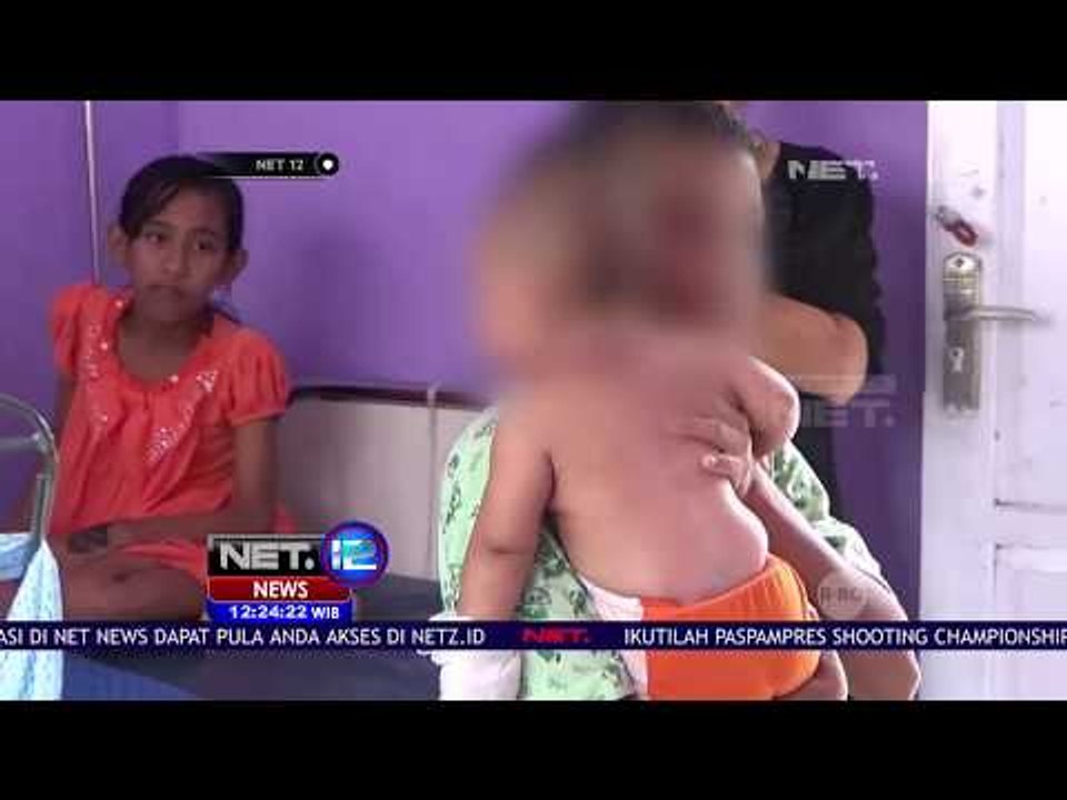Bayi Tersiram Air Panas Dirujuk Ke RSUD - NET 12