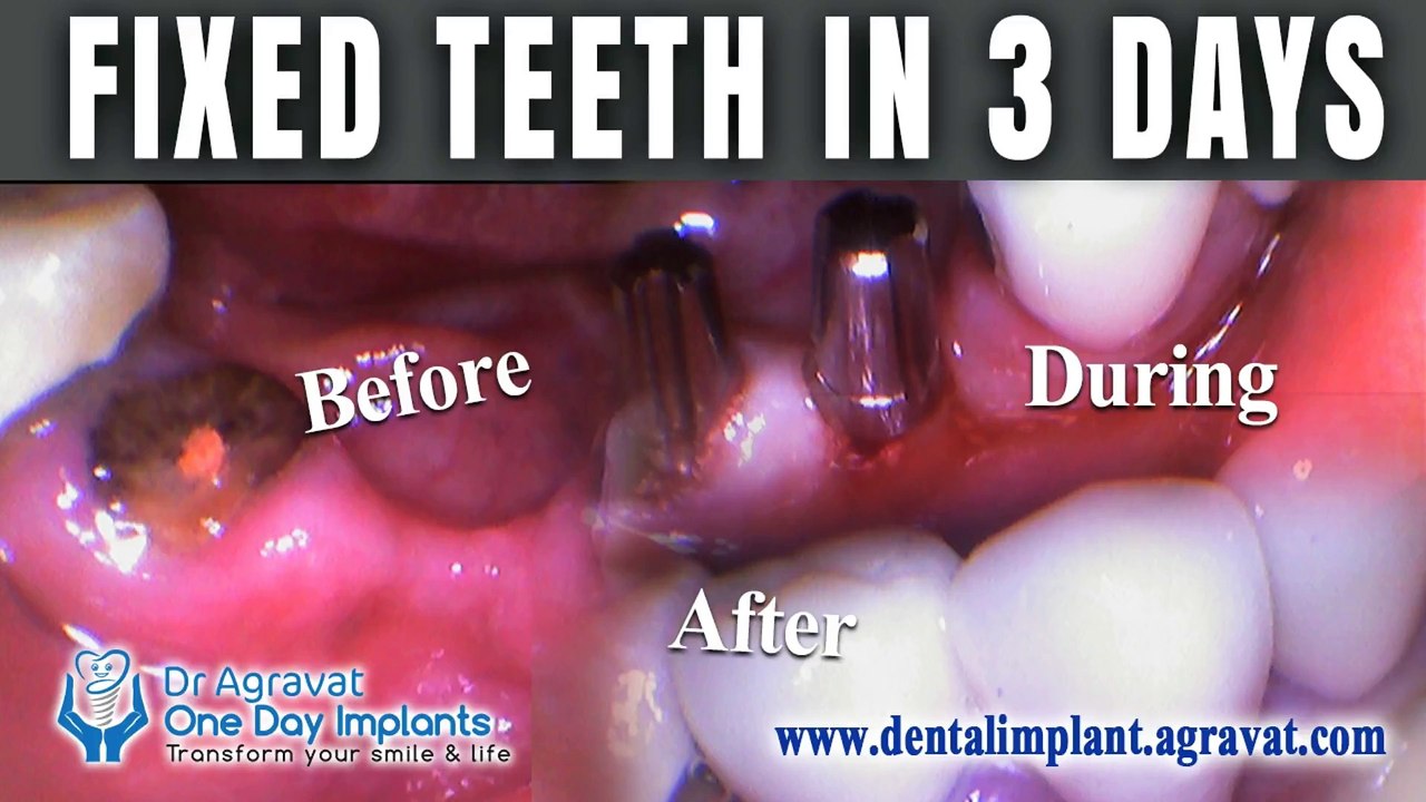 Basal Dental Implants India Review | Permanent Fixed Teeth in 3 Days | Dr Bharat Agravat (Ahmedabad)