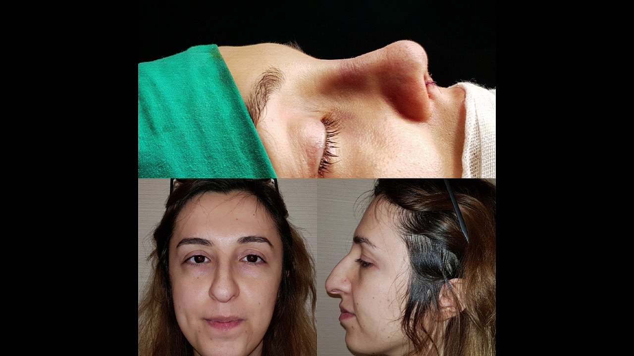 Dr Mustafa Ali Yanık burun şikayet ve çözümleri ve hasta sonuçları