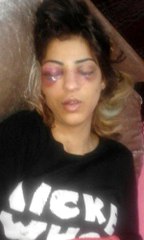 Kuma Getirdiği Sevgilisinin Elini Kırdı, Barışmak İstemeyen Eşini de Öldüresiye Dövdü