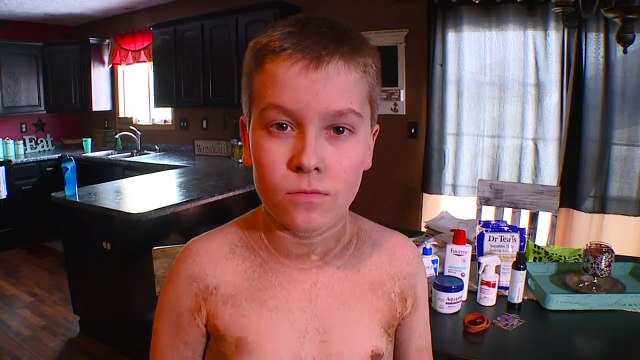 Rare Condition Prevents 12-Year-Old Boy from Sweating