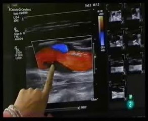 Estudio PESA: Prevencion del ictus