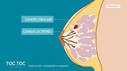 Quels sont les différents types de cancers du sein ?