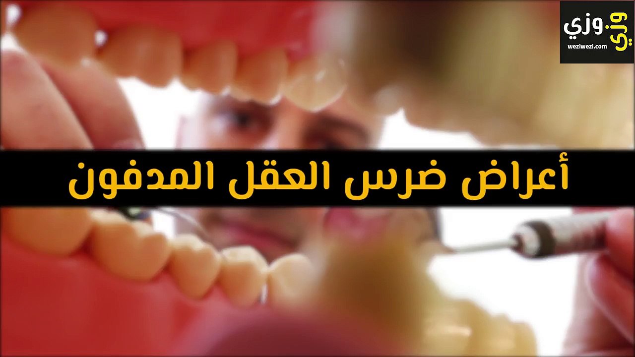 أعراض ضرس العقل المدفون