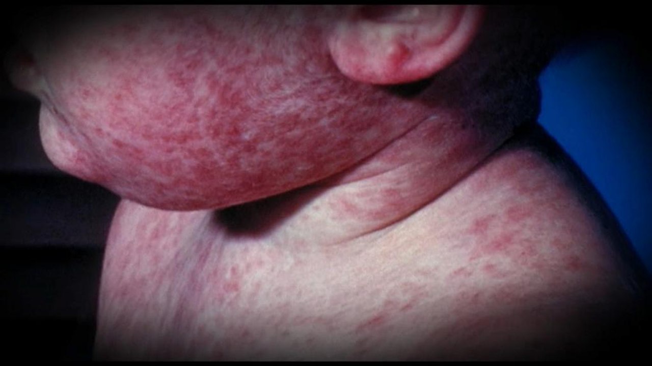 Deutlich mehr Masernfälle in Europa