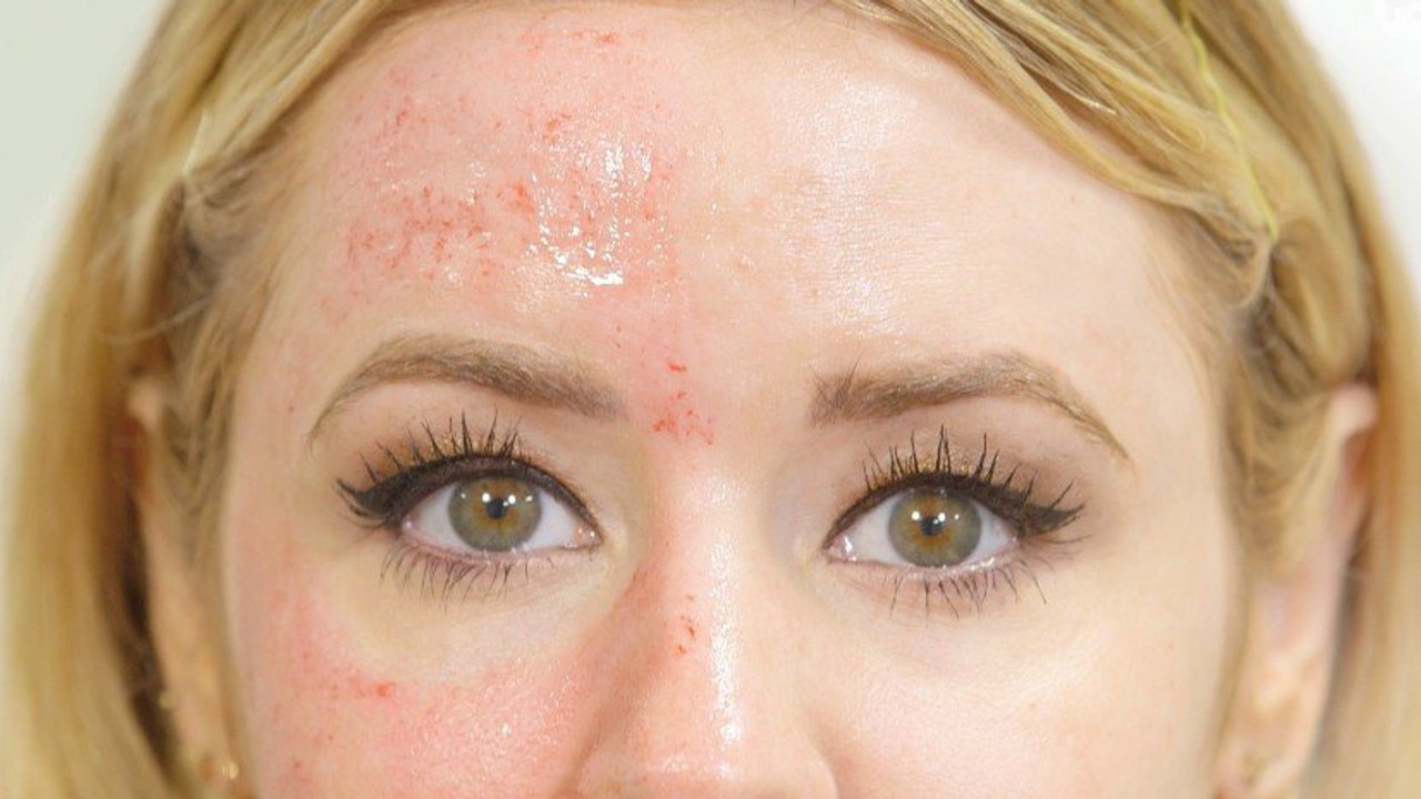 I Bled For Better Skin, and I'll Do It Again (and Again)