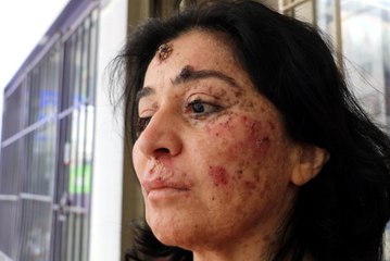 Yüzündeki Yaralar Hayatı Zindan Etti: "Deneylere Katılmak İstiyorum"