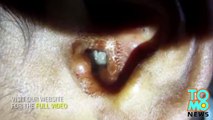 QUOI DE NEUF DOC?: Video; Un docteur extrait d’une oreille des dizaines de larves de mouche