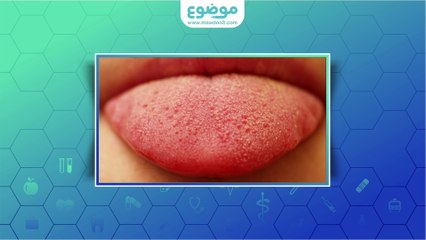 ما علاج فطريات اللسان