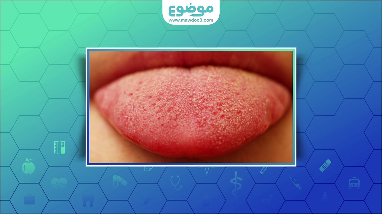 ما علاج فطريات اللسان