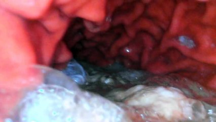 Caméra dans l'estomac : découvrez votre intérieur